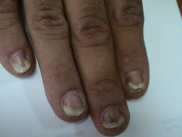 PSORIASIS - Psoriatic nails PSORIASIS - Psoriatic nails