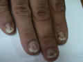 PSORIASIS - Psoriatic nails