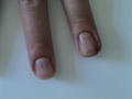 NAIL DISEASES - Acute paronychia