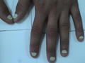 NAIL DISEASES - Leukonychia