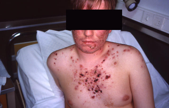 DISEASES OF THE SEBACEOUS GLANDS - Acne, Fulminans DISEASES OF THE SEBACEOUS GLANDS - Acne, Fulminans