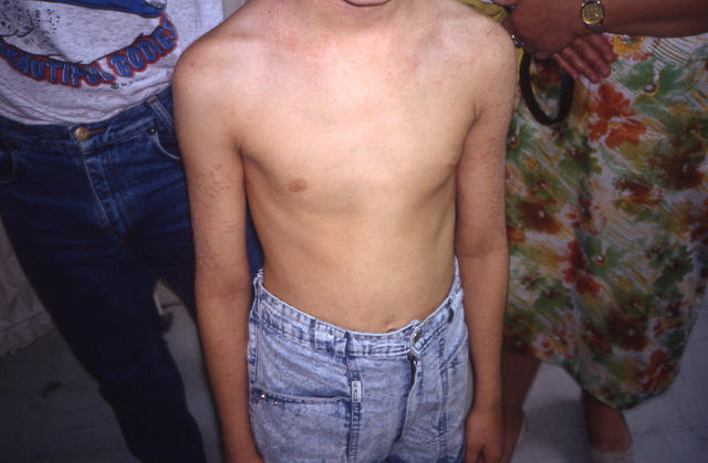 KERATINISATION DISORDERS - Darier disease KERATINISATION DISORDERS - Darier disease