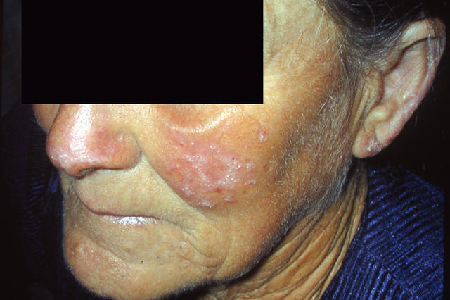 CONNECTIVE TISSUE DISORDERS - Systemc lupus erythematosus