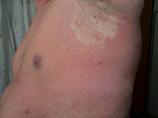 GENODERMATOSES - Netherton syndrome