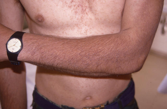 KERATINISATION DISORDERS - Darier disease KERATINISATION DISORDERS - Darier disease