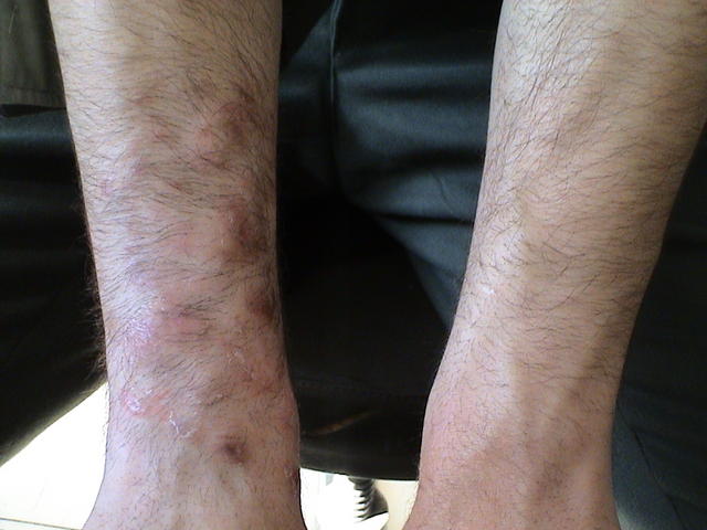 SUPERFICIAL FUNGAL INFECTIONS - Tinea Incognita SUPERFICIAL FUNGAL INFECTIONS - Tinea Incognita