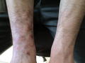 SUPERFICIAL FUNGAL INFECTIONS - Tinea Incognita