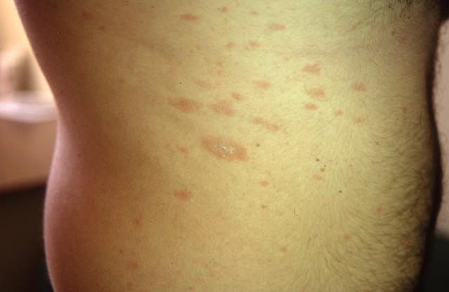 VARIOUS or of UNKNOWN ETIOLOGY DISEASES - Pityriasis rosea