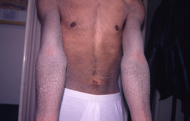 GENODERMATOSES - Ichtyosis vulgaris GENODERMATOSES - Ichtyosis vulgaris