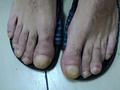 NAIL DISEASES - Clubbing