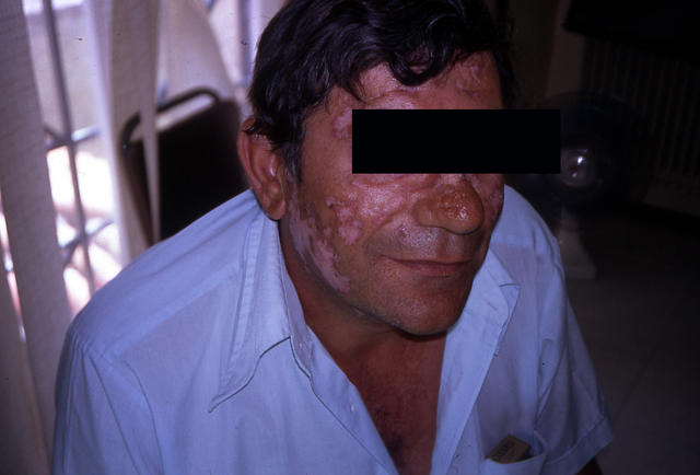 CONNECTIVE TISSUE DISORDERS - Discoid lupus erythematosus