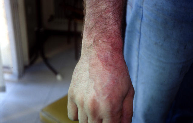 SUPERFICIAL FUNGAL INFECTIONS - Tinea infection SUPERFICIAL FUNGAL INFECTIONS - Tinea infection