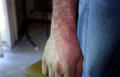 SUPERFICIAL FUNGAL INFECTIONS - Tinea infection