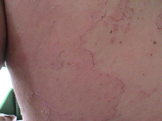 GENODERMATOSES - Netherton syndrome GENODERMATOSES - Netherton syndrome