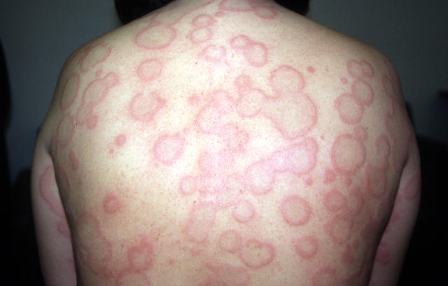 URTICARIA - Urticaria