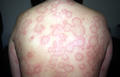 URTICARIA - Urticaria