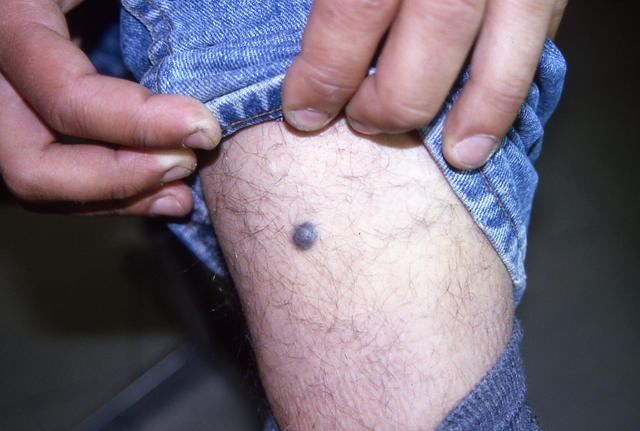 BENIGN SKIN LESIONS, NEVI, CYSTS - Blue Naevus BENIGN SKIN LESIONS, NEVI, CYSTS - Blue Naevus