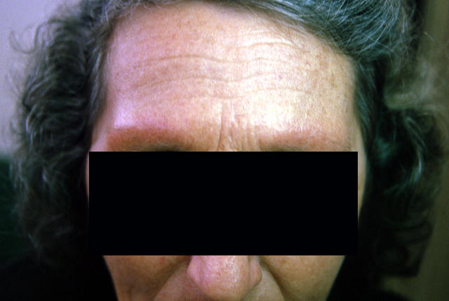 FOLLICULAR SYNDROMES WITH INFLAMMATION AND ATROPHY - Ulerythema ophryogenes