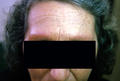 FOLLICULAR SYNDROMES WITH INFLAMMATION AND ATROPHY - Ulerythema ophryogenes