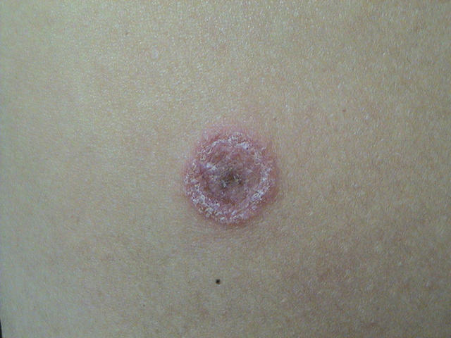 SUPERFICIAL FUNGAL INFECTIONS - Tinea infection SUPERFICIAL FUNGAL INFECTIONS - Tinea infection
