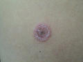 SUPERFICIAL FUNGAL INFECTIONS - Tinea infection