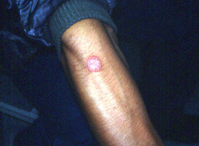 SUPERFICIAL FUNGAL INFECTIONS - Tinea infection