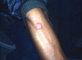 SUPERFICIAL FUNGAL INFECTIONS - Tinea infection