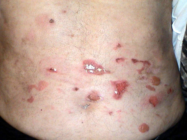 BULLOUS DISEASES - Bullous pemphigoid