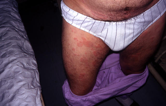 URTICARIA - Urticaria