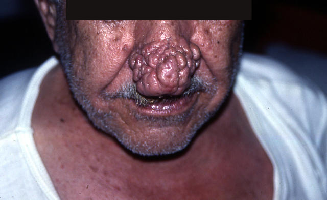 DISEASES OF THE SEBACEOUS GLANDS - Rhinophyma DISEASES OF THE SEBACEOUS GLANDS - Rhinophyma