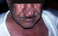 DISEASES OF THE SEBACEOUS GLANDS - Rhinophyma