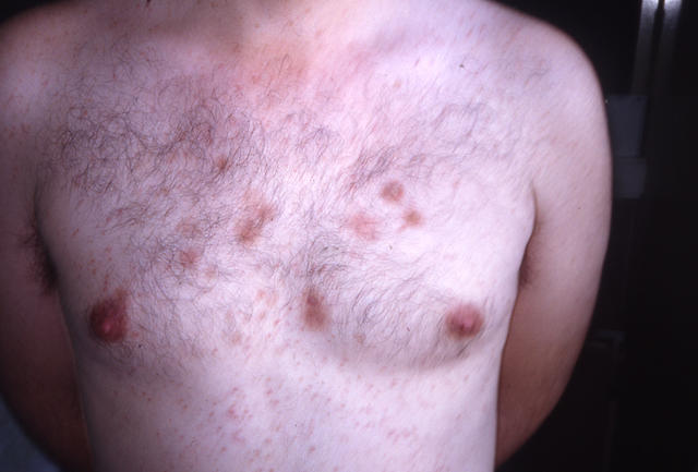 BULLOUS DISEASES - Pemphigus erythematosus