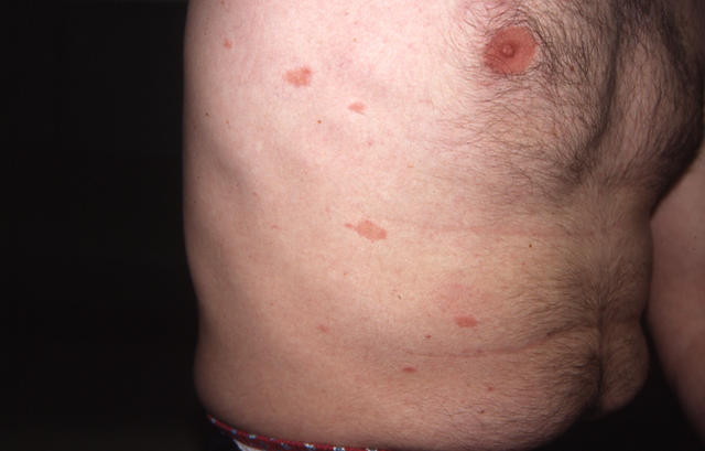 VARIOUS or of UNKNOWN ETIOLOGY DISEASES - Pityriasis rosea