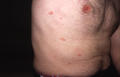 VARIOUS or of UNKNOWN ETIOLOGY DISEASES - Pityriasis rosea