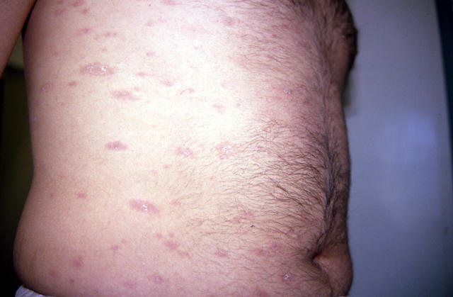 VARIOUS or of UNKNOWN ETIOLOGY DISEASES - Pityriasis rosea