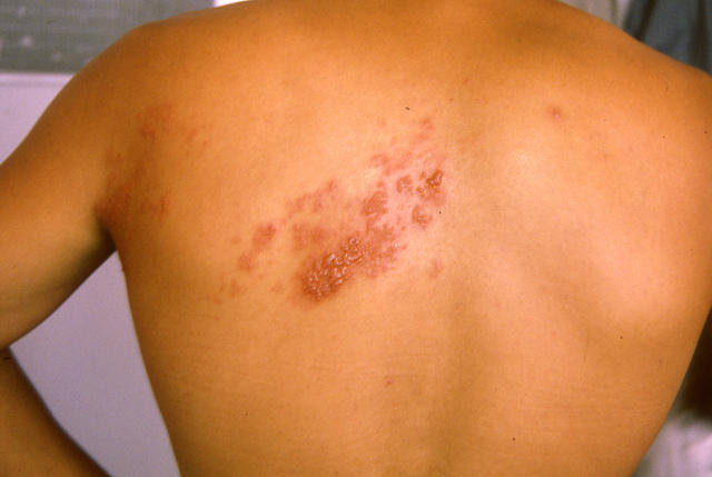 VIRAL INFECTIONS - Herpes Zoster