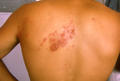 VIRAL INFECTIONS - Herpes Zoster