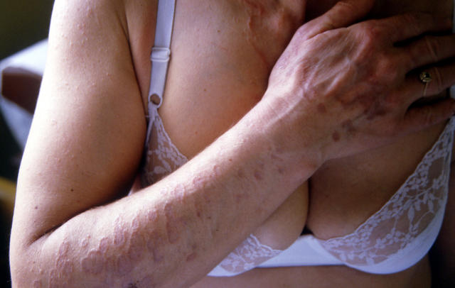 NECROBIOTIC DISORDERS - Granuloma Annulare NECROBIOTIC DISORDERS - Granuloma Annulare