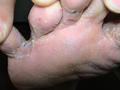 SUPERFICIAL FUNGAL INFECTIONS - Tinea