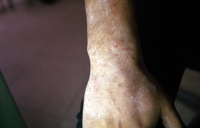 SUPERFICIAL FUNGAL INFECTIONS - Tinea corporis due to trichophyton SUPERFICIAL FUNGAL INFECTIONS - Tinea corporis due to trichophyton