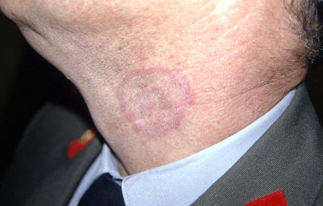 SUPERFICIAL FUNGAL INFECTIONS - Tinea SUPERFICIAL FUNGAL INFECTIONS - Tinea