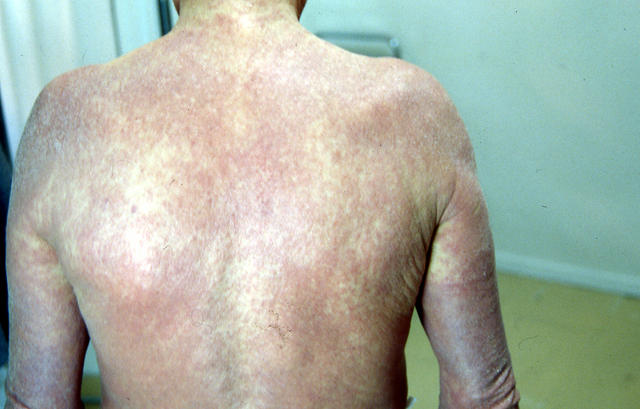 VARIOUS or of UNKNOWN ETIOLOGY DISEASES - Erythroderma VARIOUS or of UNKNOWN ETIOLOGY DISEASES - Erythroderma