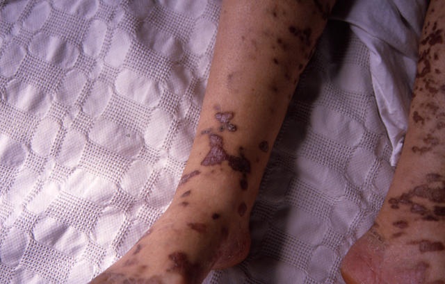 SOFT TISSUE TUMORS - Kaposi sarcoma SOFT TISSUE TUMORS - Kaposi sarcoma