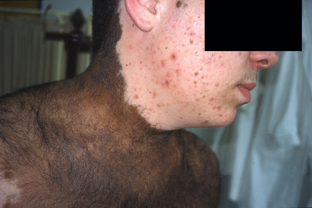 BENIGN SKIN LESIONS, NEVI, CYSTS - Congenital, giant, hairy, melanocytic naevus