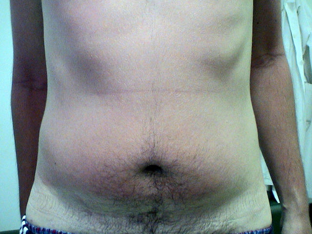 AGEING, PHOTOAGEING - Solar burn AGEING, PHOTOAGEING - Solar burn