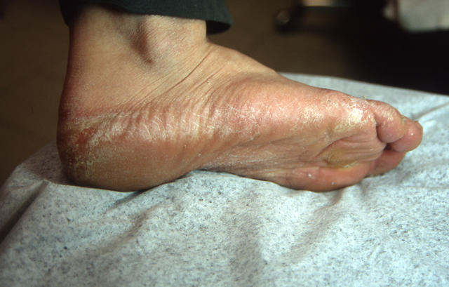 SUPERFICIAL FUNGAL INFECTIONS - Tinea pedis (Athlet's foot)