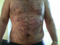 PSORIASIS - Generalized psoriasis