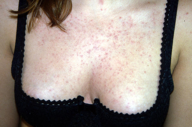 KERATINISATION DISORDERS - Darier disease KERATINISATION DISORDERS - Darier disease