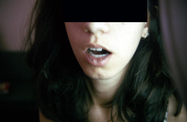 PIGMENTATION DISORDERS - Peutz - Jeghers syndrome PIGMENTATION DISORDERS - Peutz - Jeghers syndrome