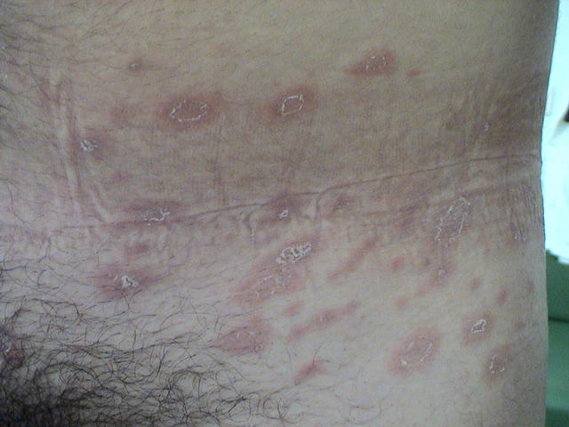 VARIOUS or of UNKNOWN ETIOLOGY DISEASES - Pityriasis rosea VARIOUS or of UNKNOWN ETIOLOGY DISEASES - Pityriasis rosea